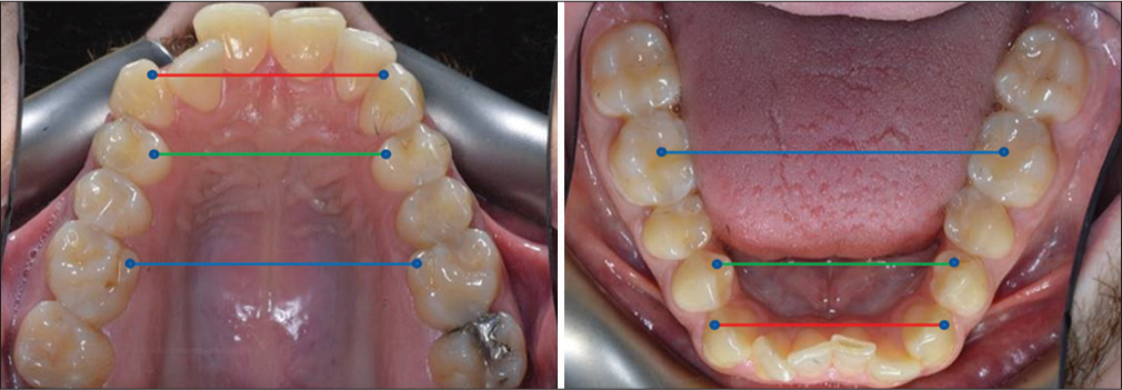 Landmark illustration for maxillary transverse discrepancy assessment