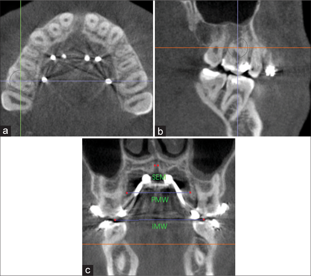 Measurement of sutural expansion (SEM), palatal maxillary width (PMW) and intermolar width (IMW) on a coronal cross-sectional slice through the midportion of M1. Orientation of landmarks on the a) axial plane; b) sagittal plane; and c) coronal plane