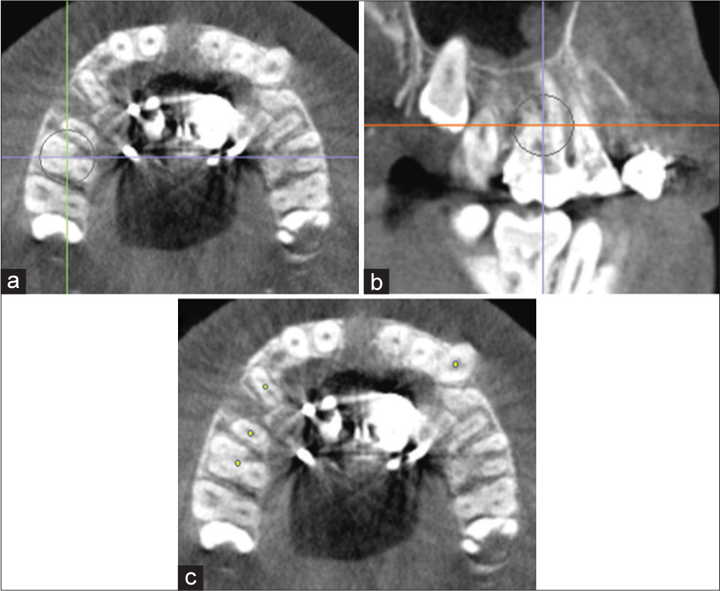 Identification of canine (C), first premolar (P1), second premolar (P2) and first molar (M1) on an axial cross-sectional slice through M1 Furcation. Orientation of landmarks on the a) axial plane; b) sagittal plane; and c) axial plane