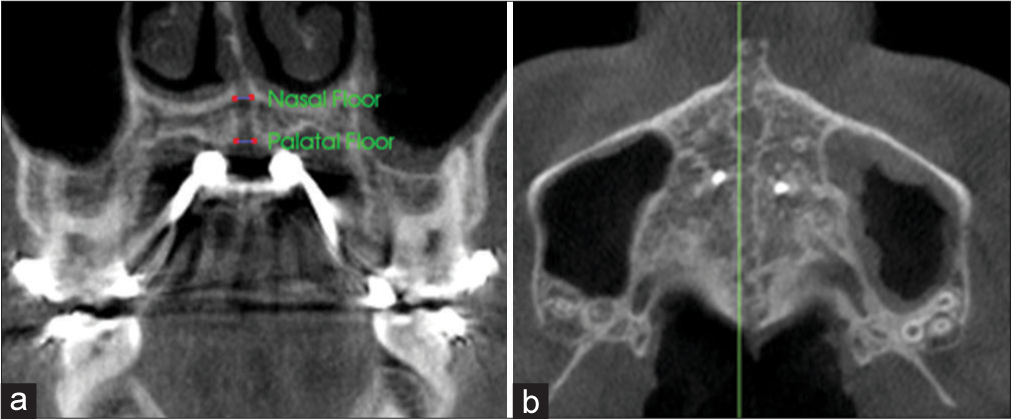 Measurement of sutural expansion at the nasal and palatal floor on a coronal cross-sectional slice through the midportion of M1. Orientation of landmarks on the a) coronal plane; and b) axial plane.