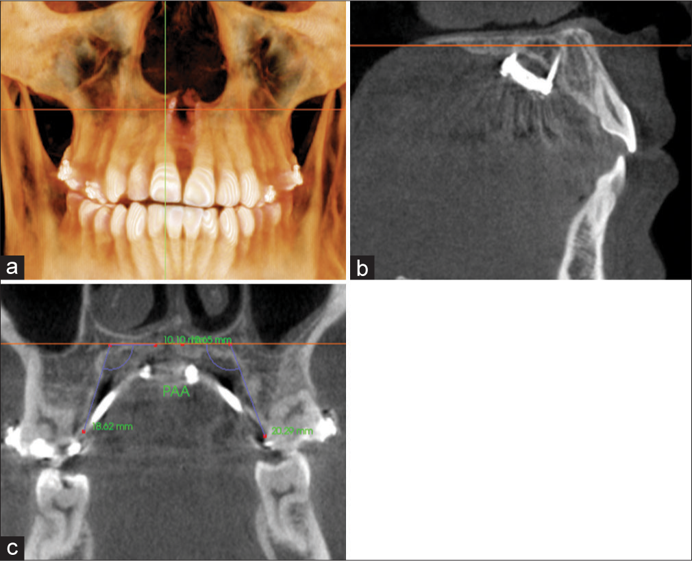 Measurement of palatal alveolar angle (PAA) for M1 on a coronal cross-sectional slice through the midportion of the tooth. Orientation at the a) coronal plane; b: sagittal plane; and c) coronal plane