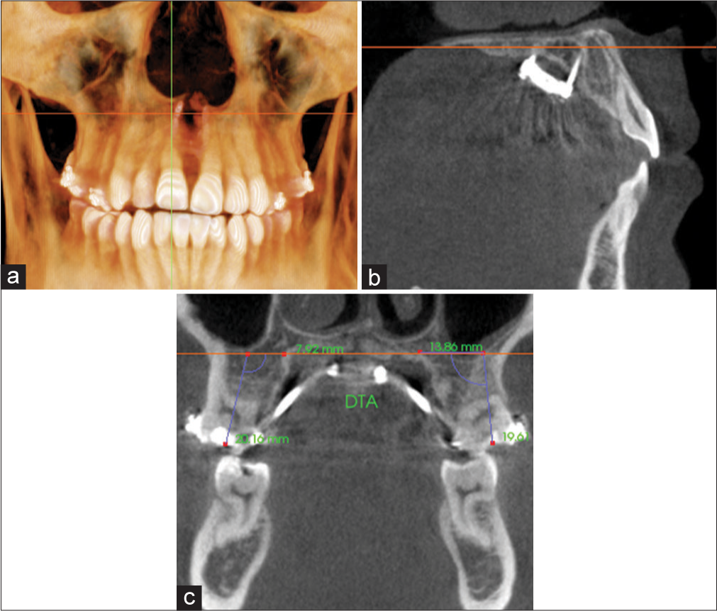 Measurement of dental tipping angle (DTA) for M1 on a coronal cross-sectional slice through the midportion of the tooth. Orientation at the a) coronal plane; b) sagittal plane; and c) coronal plane