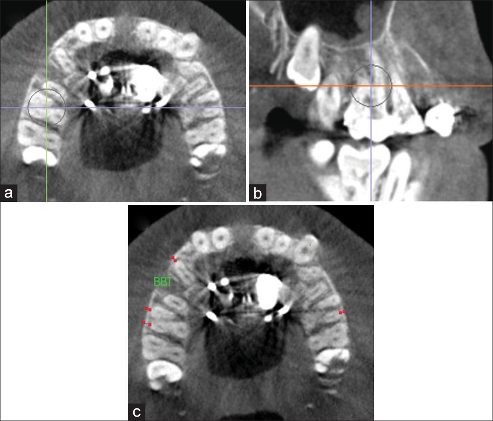 Measurement of buccal bone thickness (BTT) for P1 and mesiobuccal and distobuccal root of M1 on an axial cross-sectional slice through the furcation of M1. Orientation at the a) axial plane; b) sagittal plane; and c) axial plane