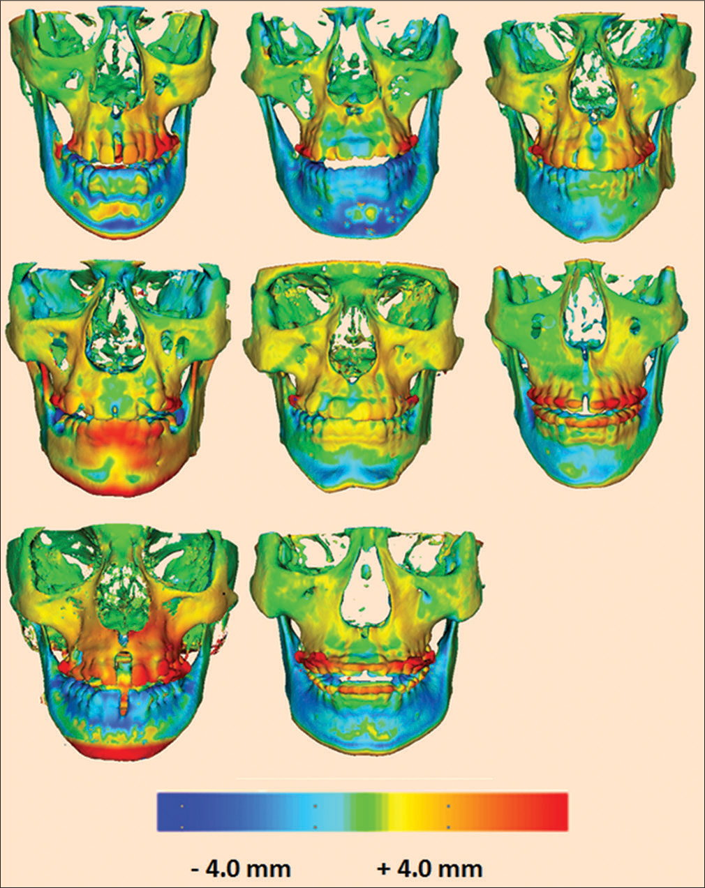 Three-dimensional skeletal color maps of superimpositions of T2 over T1 registered at the anterior cranial base with a scale of -4 to +4 mm. Red represents outward displacement of T2 relative to T1. Blue represents inward displacement of T2 relative to T1