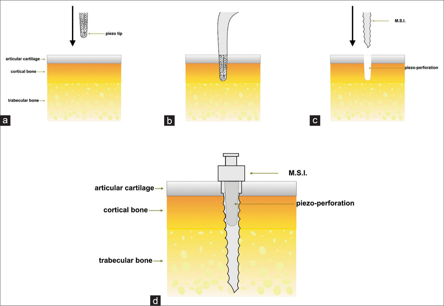 Morphological description of cortical piezo-puncture with piezotome insert (a and b). Subsequent insertion of miniscrew implants (c and d)