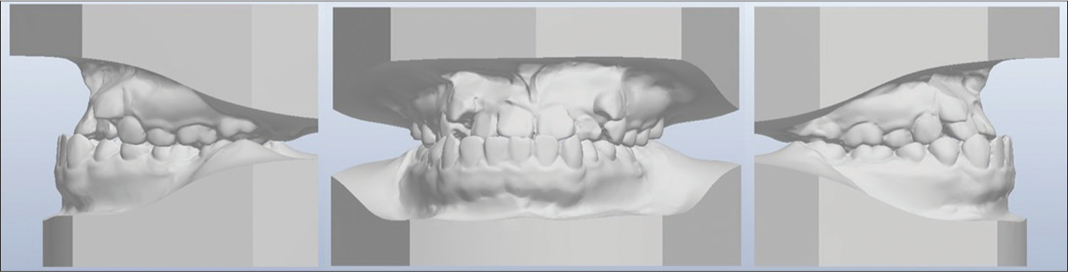 Digital model in standard preset “In-occlusion” buccal and anterior views