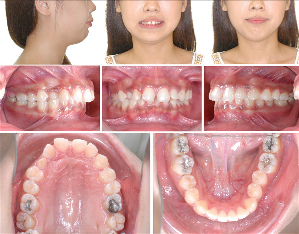 Pretreatment facial and intraoral photographs