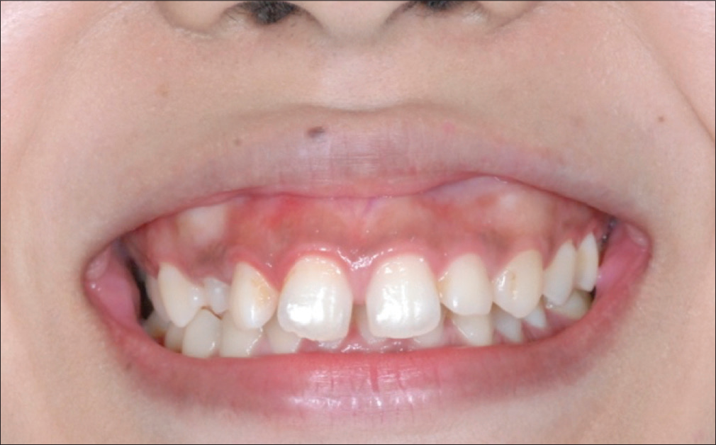 Gummy smile, asymmetrical gingival display, and occlusal canting are documented in a frontal photograph