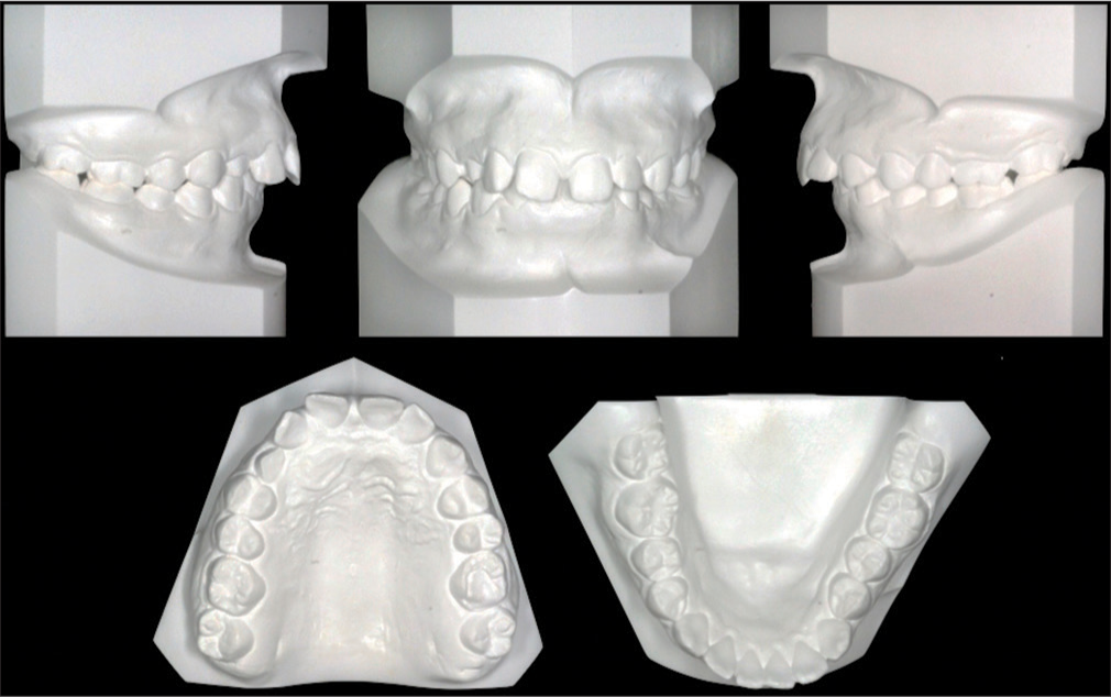 Pretreatment dental models (casts)