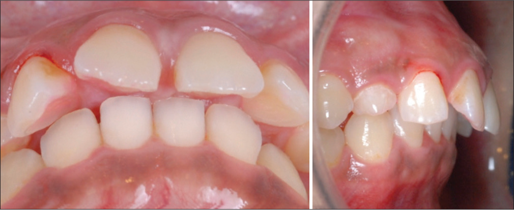 Inferior (left) and lateral (right) intraoral views show Impinging (100%) anterior deep bite and large overjet (7.5 mm)