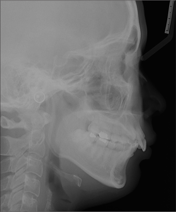 Pretreatment lateral cephalometric radiograph