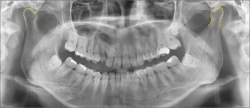 Pretreatment panoramic radiograph shows both condylar heads outlined in yellow
