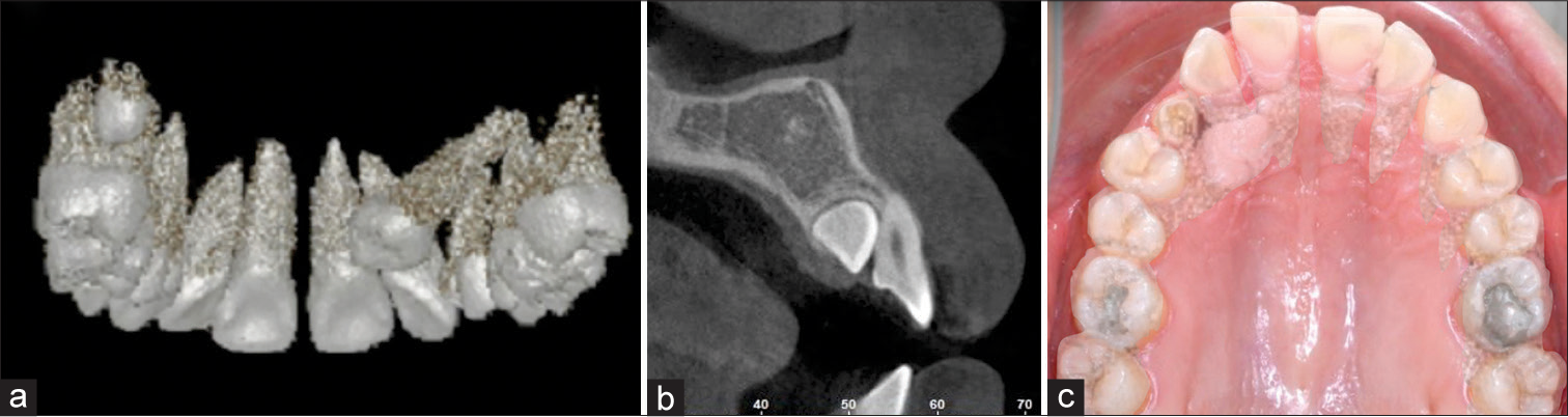 (a) Three-dimensional image of the maxillary dentition documents the relative position of the impacted canine. (b) A sagittal cut through the UR2 region of a cone-beam computed tomography image shows a cross-section through the cervical region of the impacted UR3. (c) A cone-beam computed tomography image of the maxillary arch is superimposed on an occlusal intraoral photograph to reveal the position of the impacted canine