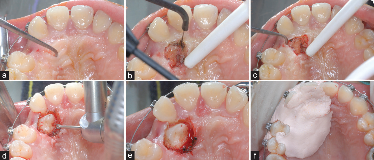 (a) The simplified open window technique begins with precise location of the crown of the impaction by sounding through the soft tissue to detect enamel. (b) The palatal soft tissue covering the crown is removed with electrosurgery. (c) An explorer is used to penetrate the overlying cervical bone to estimate the location of the cementoenamel junction. (d) Bone covering the crown is carefully removed with a round bur in a high-speed handpiece down to the level of the cementoenamel junction. (e) Canine crown is exposed without severing the greater palatine artery or damaging the tooth. (f) COE-PAK® periodontal dressing is placed for patient comfort and to prevent soft tissue from recovering the exposed crown