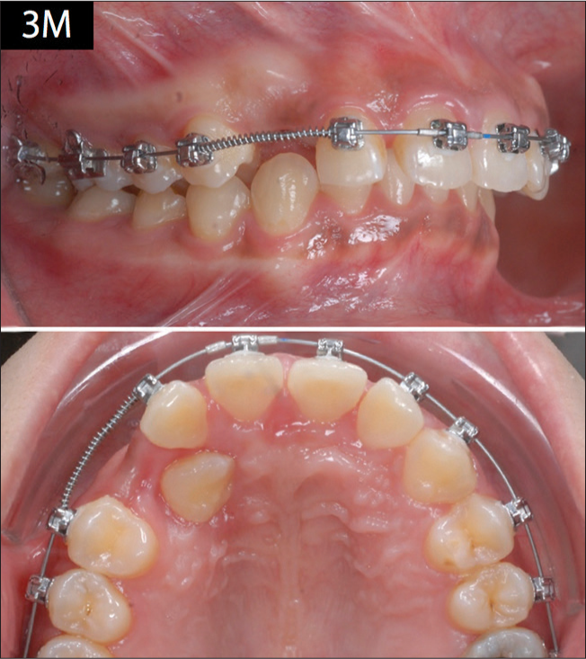 In the 3rd month of treatment, an open-coil spring was placed between the right maxillary lateral incisor and first premolar to create space to align the impacted canine