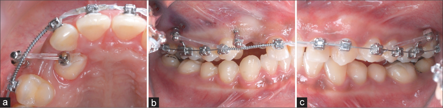 (a) In the 4th month, a miniscrew is placed between the 1st premolar and canine position and loaded with 150 g-force (cN) of traction to move the impacted canine into its correct anatomical position. (b) A right lateral intraoral radiograph shows the mechanism for retraction of the right buccal segment as the palatally displaced canine is moved into the arch. (c) A left lateral view reveals symmetric mechanics to retract the left buccal segments with 280 g-force (cN) per side