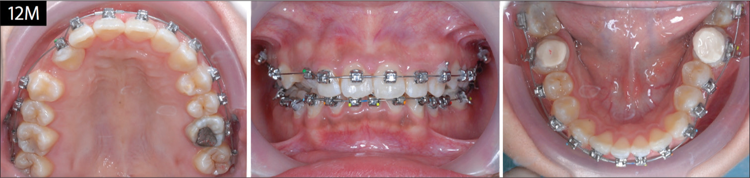 In the 12th month of treatment brackets are bonded to the maxillary right canine (left) and also on the entire lower arch (center). BTs are noted on the occlusal surfaces of the mandibular first molars (right)