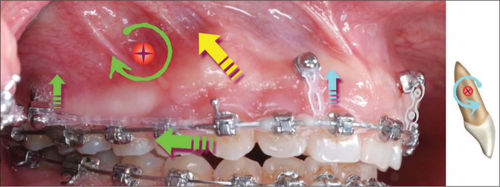 Based on a presumed CR for the maxillary arch (red circle with a cross), the chain of elastics from the infrazygomatic crest bone screw to the cuspid bracket has distal and vertical components (straight green arrows) that produce a clockwise moment around the CR. The maxillary anterior miniscrew anchors an intrusive force (blue arrow) that creates a counterclockwise moment (blue curved arrow) tending to flare the maxillary incisors. The presumed resultant for all the applied loads is the yellow arrow. CR – Center of resistance
