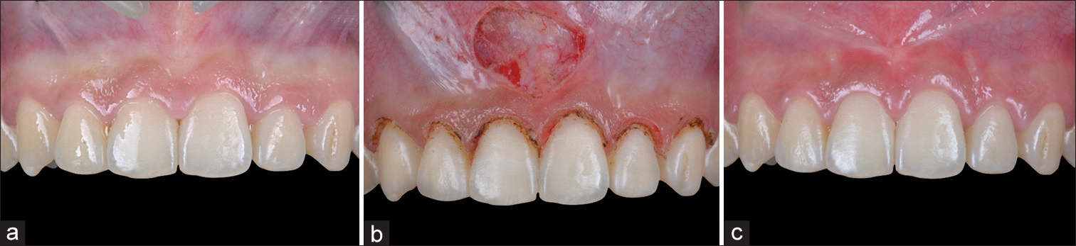 (a) Preoperative photograph shows the irregular gingival margins and clinical crown lengths in the maxillary anterior esthetic zone. There is also a low attachment of the maxillary midline frenum. (b) Image taken immediately after diode laser gingivectomy and frenectomy which was performed 2 months into active treatment. (c) Follow-up 1 month later shows esthetically pleasing tooth proportions and gingival contours, as well as an apical migration of the revised frenum attachment