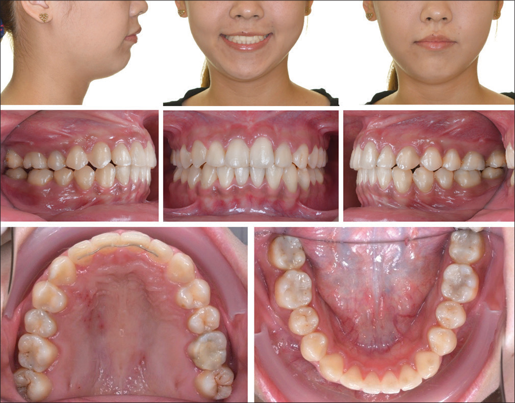 Posttreatment facial and intraoral photographs