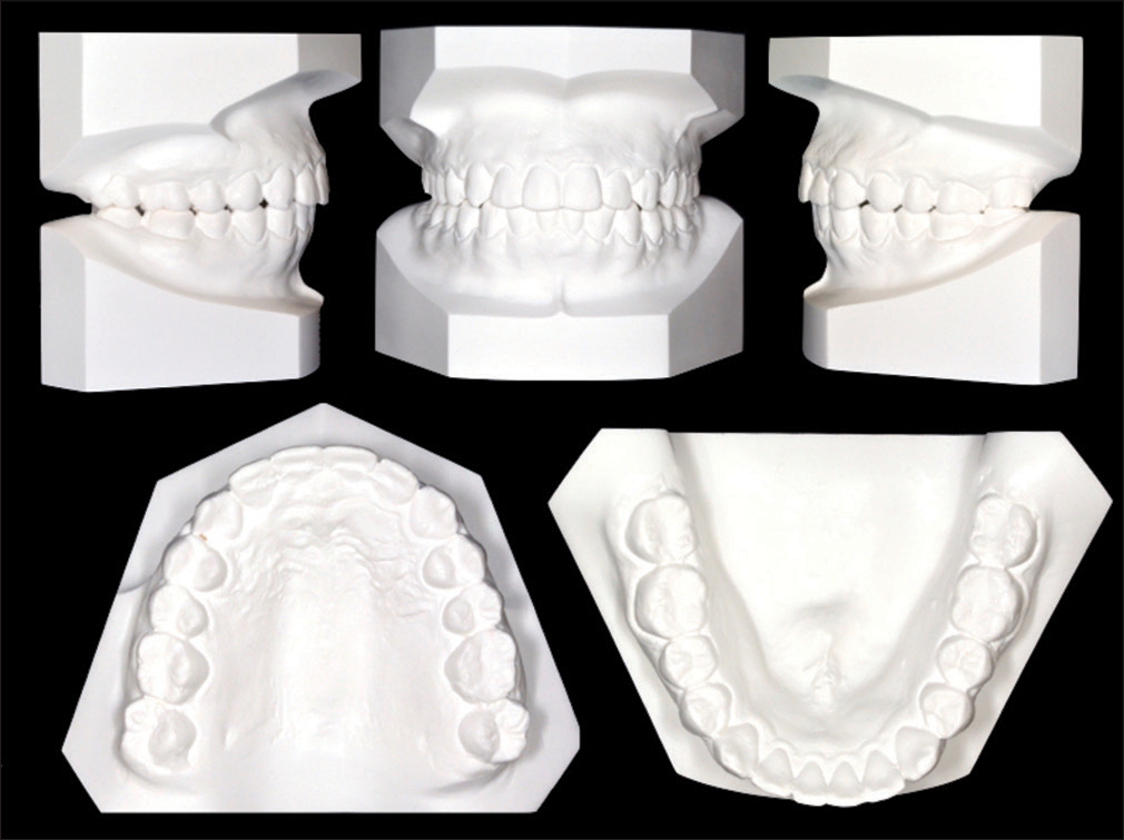 Posttreatment dental models (casts)