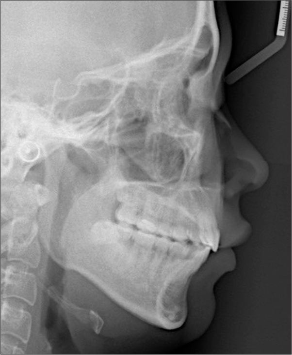 Posttreatment lateral cephalometric radiograph