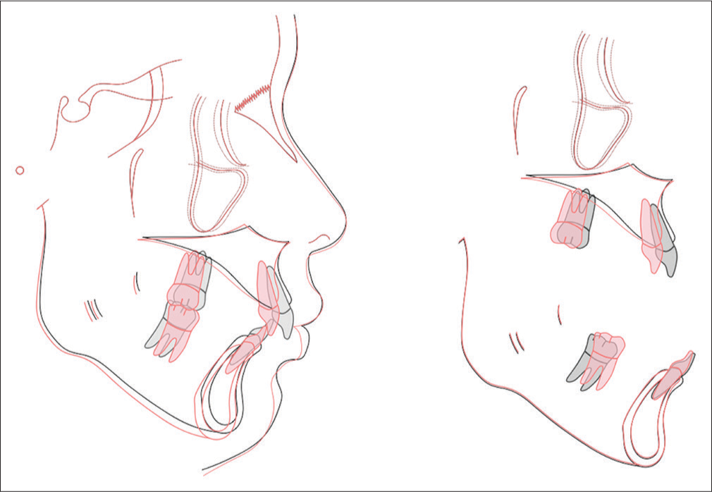 Superimposed cephalometric tracings showing dentofacial changes resulting from 32 months of active treatment (red) compared to the pretreatment (black). Note that the maxilla and particularly the maxillary incisors did not move as expected in the presumed loading diagram [Figure 12]