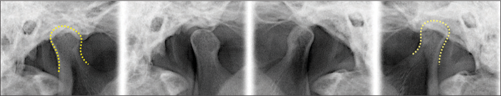 Posttreatment temporomandibular joint radiographs show that mandibular contours and articular relationships are within normal limits for both on the right and left sides. The open and closed positions for the right temporomandibular joint are shown in the two images on the left side, and the same relationships for the left temporomandibular joint are shown on the right side of the illustration