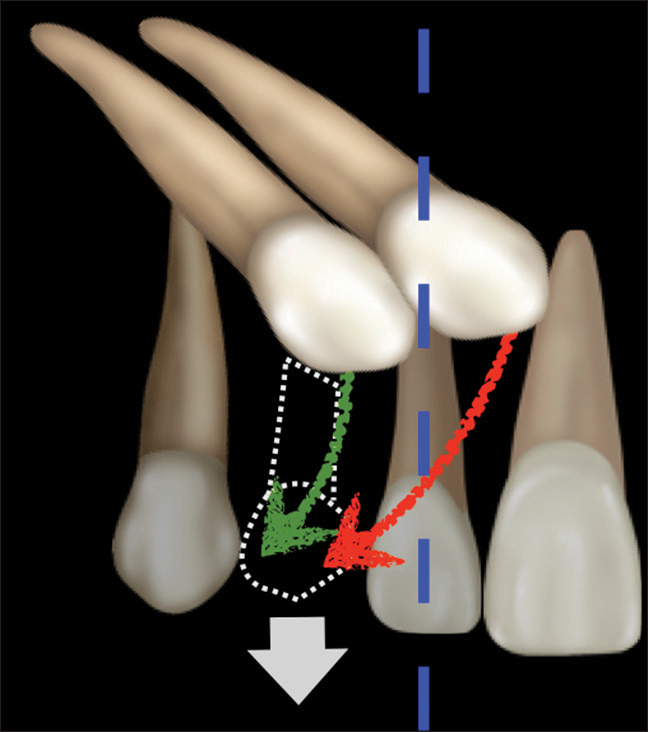Illustration of the concept proposed by Ericsson and Kurol (1988) for prevention of maxillary permanent canine impaction by the timely extraction of the retained deciduous canine (outline dotted in white) and space opening if needed to accommodate the erupting canine. The probable success of the procedure depends on the sagittal position of the unerupted canine relative to the midline of the maxillary canine in a two-dimensional radiograph