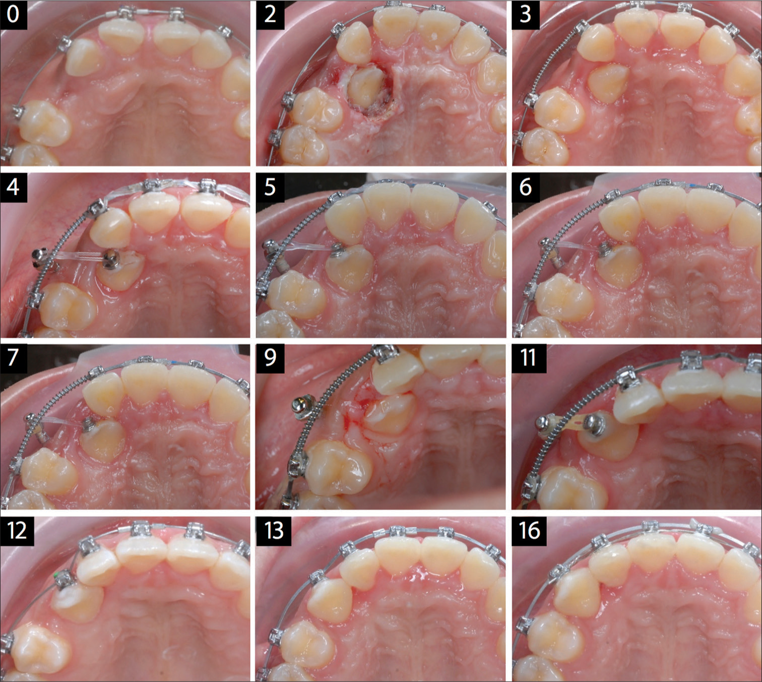 The progression for the recovery and alignment of the palatally impacted right maxillary canine is shown in a series of occlusal photographs taken at monthly intervals from the start of treatment at zero months to completion of the initial alignment at 16 months