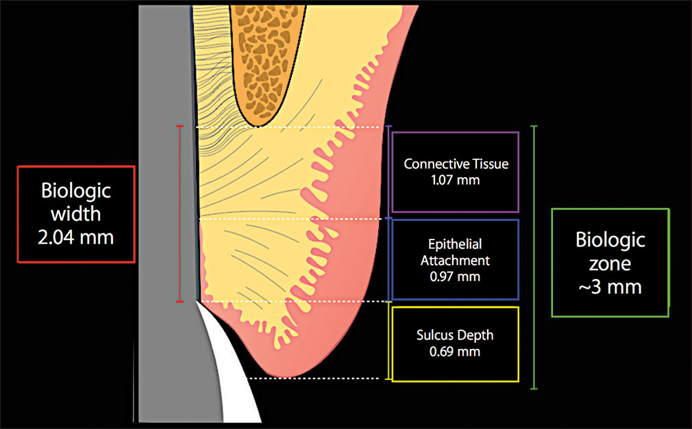 A diagram of the periodontal attachment to a tooth illustrates the concept of biologic width: sulcus depth + width of the epithelial attachment + connective tissue attachment of collagen fibers directly into cementum occlusal to the alveolar bone crest. The total width of the biologic zone is ∼3 mm