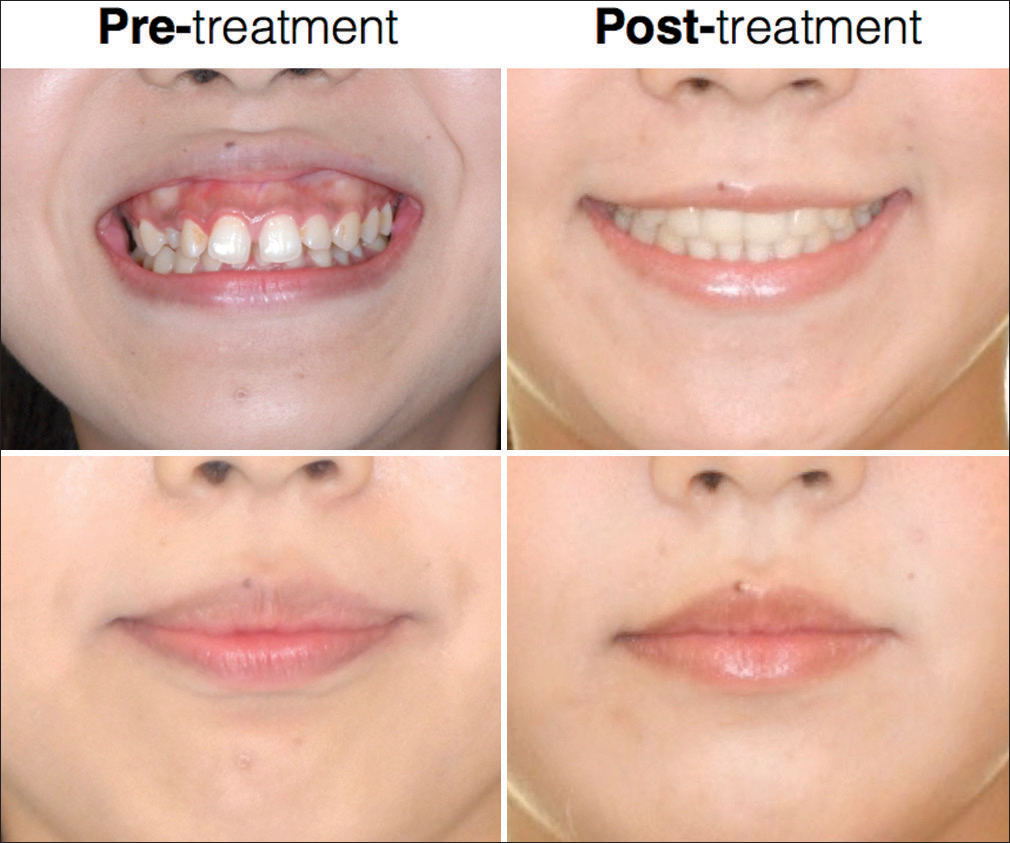 Pretreatment (left) and posttreatment (right) lower facial photographs. The upper two views are a comparison of full smile before and after treatment. The lower two photos area similar comparison with the lips closed