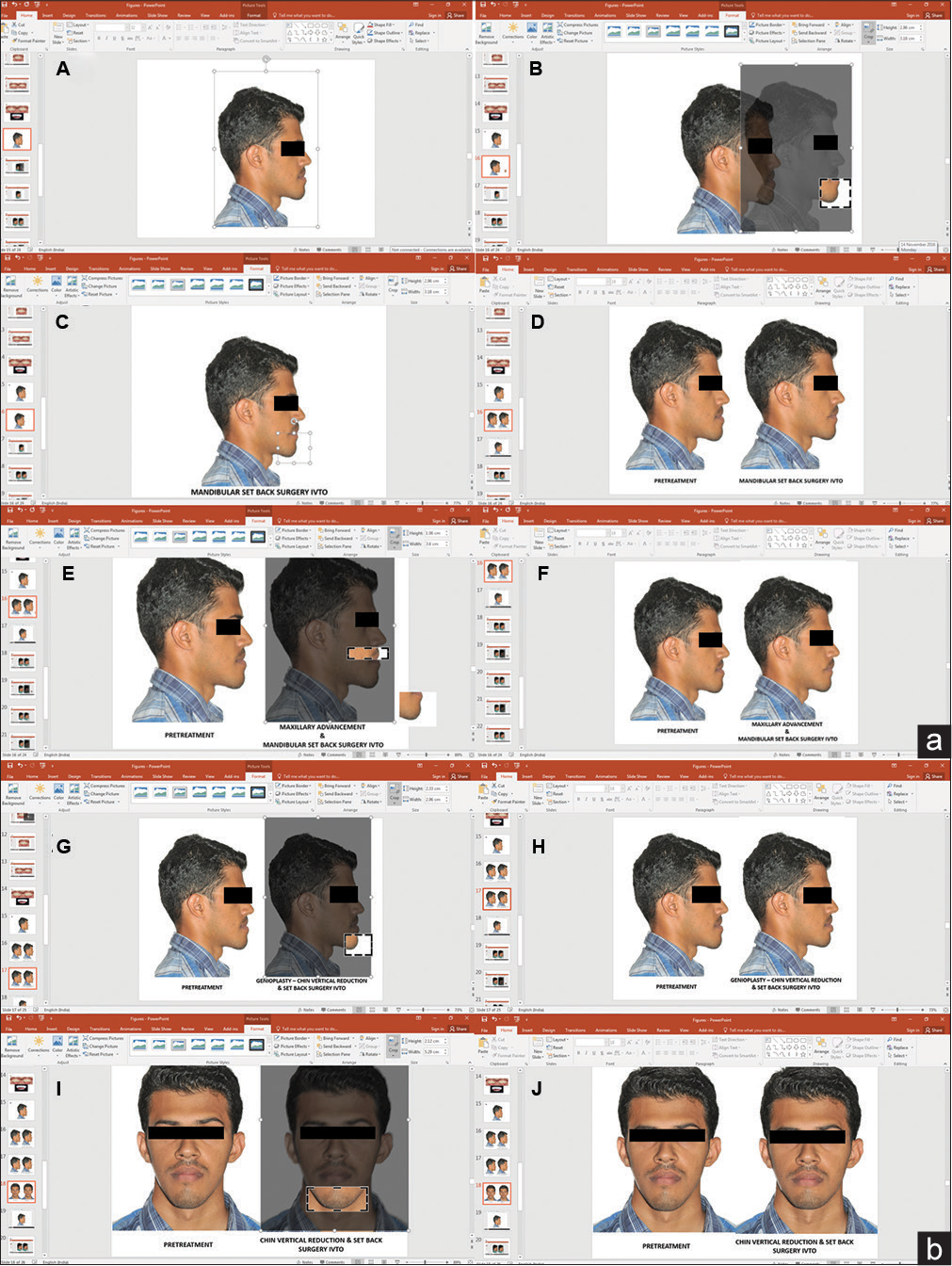 (a) Skeletal IVTO for mandibular setback and maxillary advancement. A. Extra oral profile photograph imported. B. Mandible cropped around chin. C. Cropped image moved back to mandibular setback position. D. IVTO compared with pretreatment photograph. E. Maxilla cropped below subnasale. F. Cropped maxilla advanced with mandibular setback. (b) Skeletal IVTO for setback and vertical reduction genioplasty. G. Chin cropped. H. Chin repositioned vertically up. I. Chin cropped from frontal image. J. Chin repositioned vertically up on the frontal image for vertical reduction genioplasty