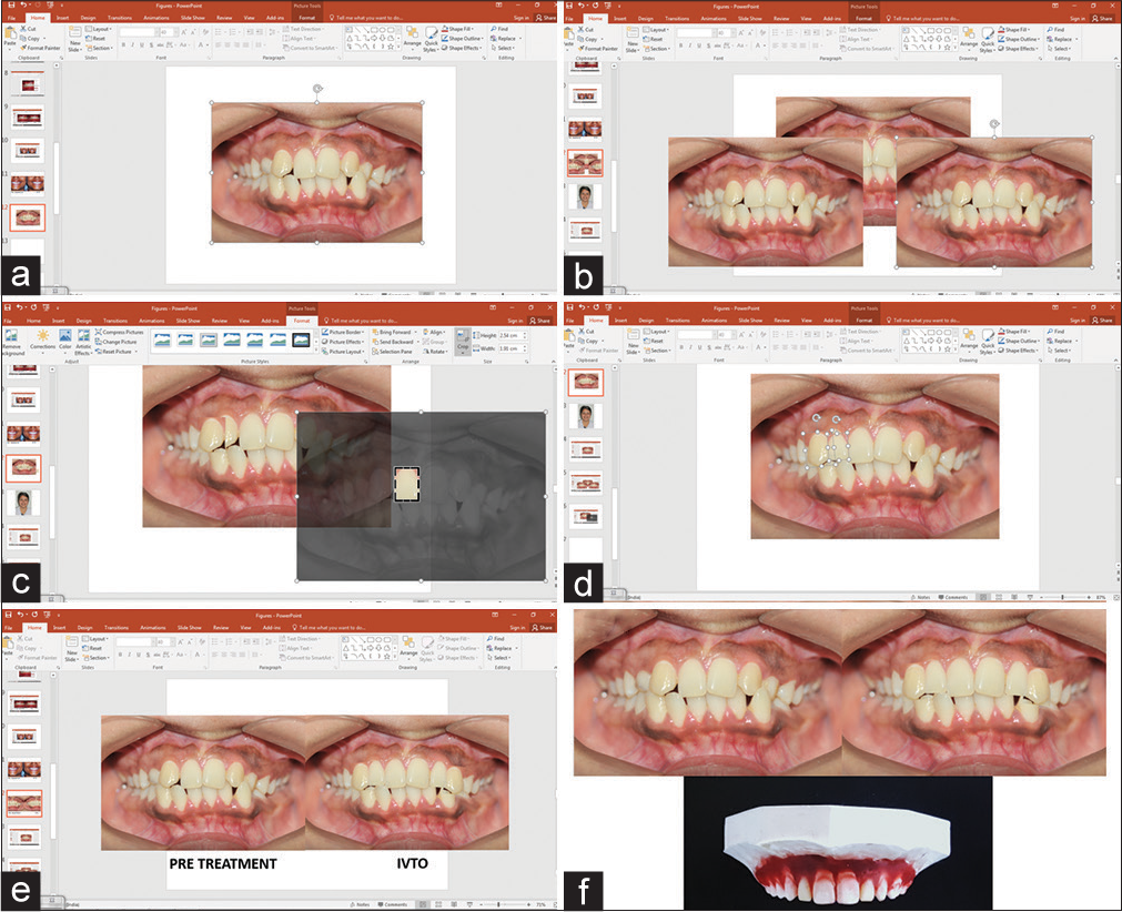 Dental IVTO for bilateral missing maxillary lateral incisors with transpositioned canines. (a) Imported Pretreatment image, (b) Image copied and pasted for cropping individual tooth, (c) Maillary central incisor cropped and image resized to resemble lateral incisor, (d) transpositioned maxillary canine cropped and moved distally, (e) Final positioning of cropped images overlapped bilaterally to mimic lateral incisor replacement, (f) Dental IVTO compared with pretreatment and model setup