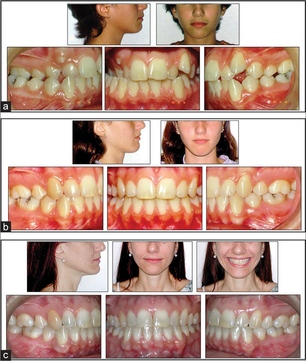 Orthodontic Finishing Ten Steps to Success APOS Trends in