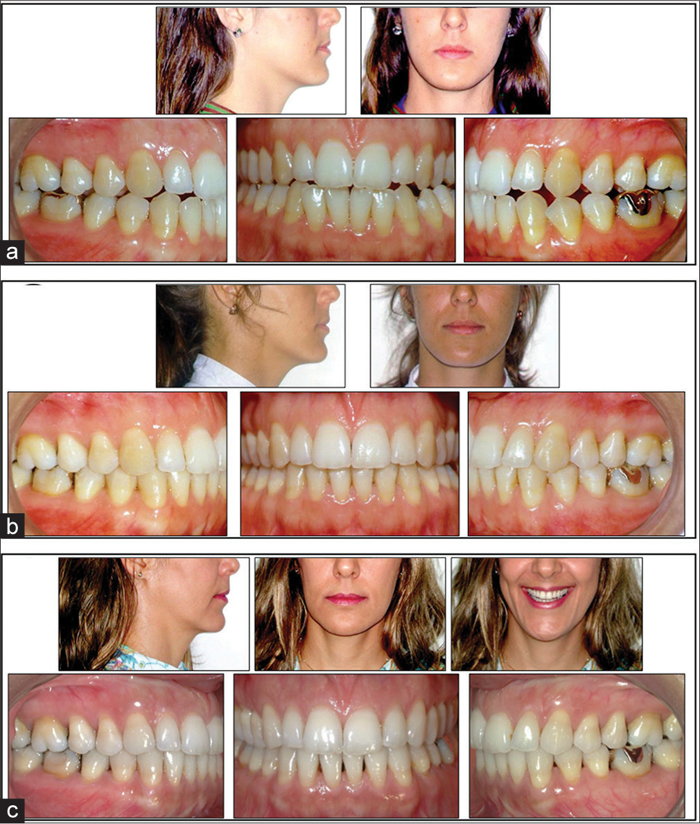 What to expect during brace treatment? The active phase! « Queensway  Orthodontics Blog