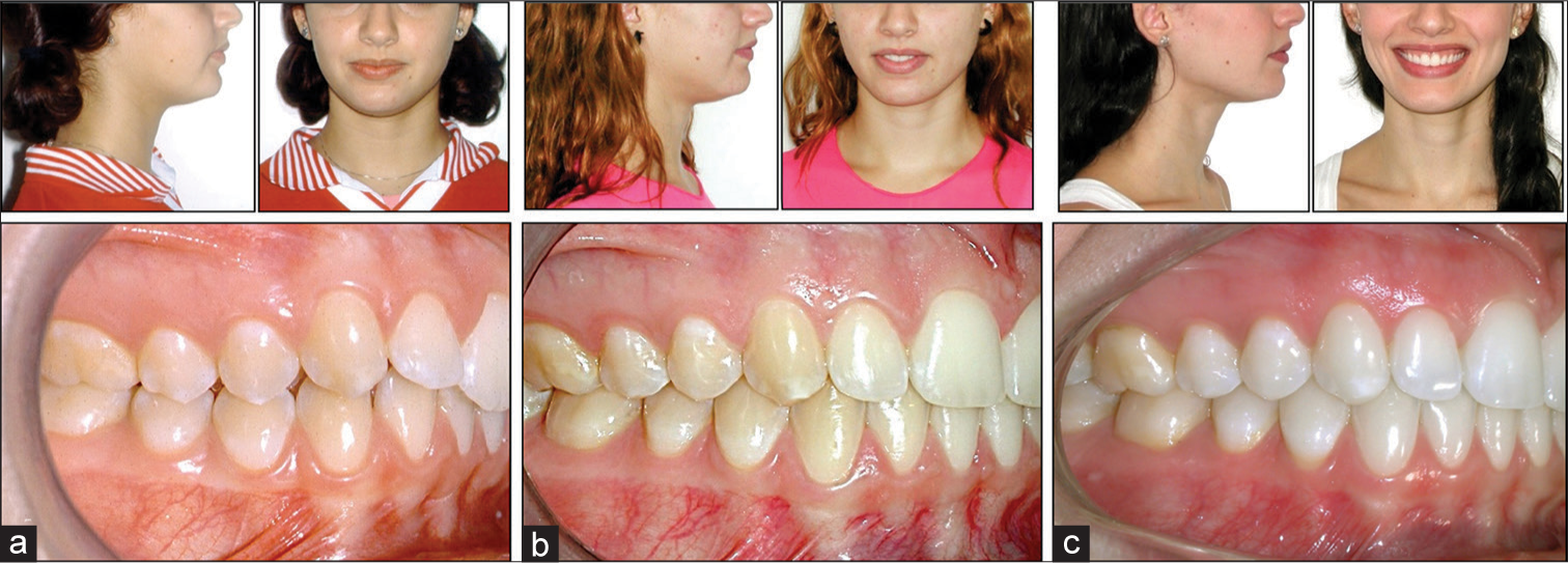 (a) Before treatment, patient age 15 years and 11 months. (b) At the end of treatment, at age 17 years and 11 months. (c) A patient with 28 years and 10 months and 11 years and 10 months follow-up with very stable results