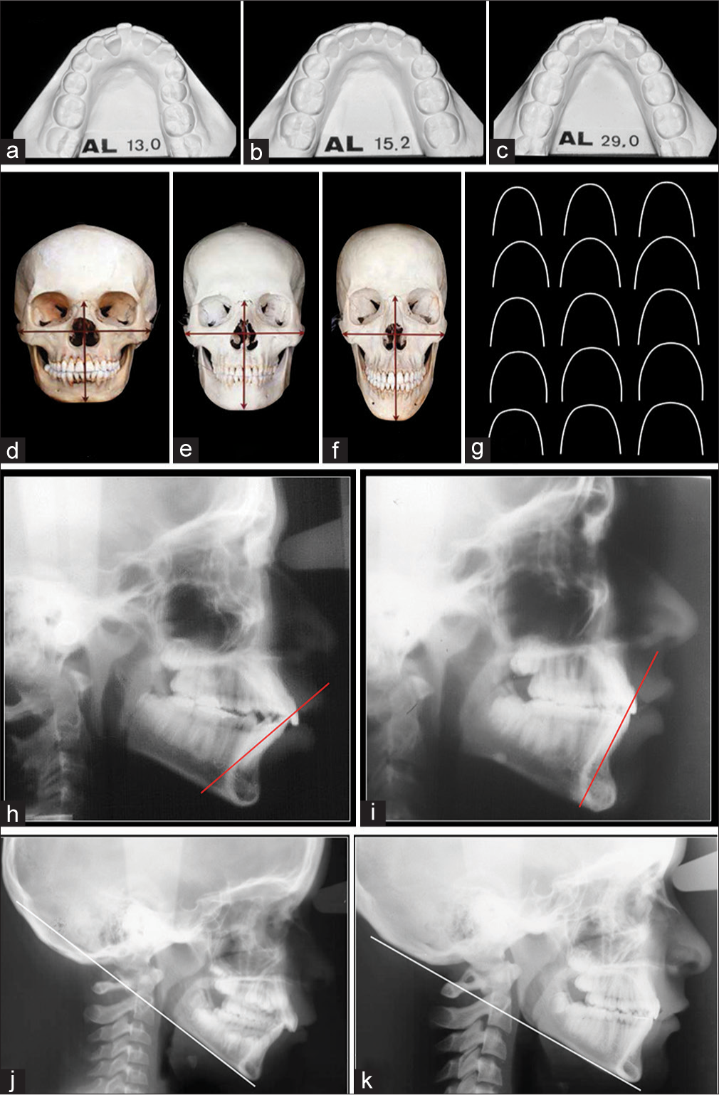 Increase in intercanine distance, even with extractions of premolars, resulted in relapse. (a) Before treatment. (b) At the end of treatment. (c) Relapses 14 years later. (d-g) Different individuals have different skull forms and consequently different shapes and sizes of dental arches. (h and i) The objectives are to maintain lower incisors positions or upright them. (j and k) Maintain mandibular plane angle – or even to reduce in Class II cases