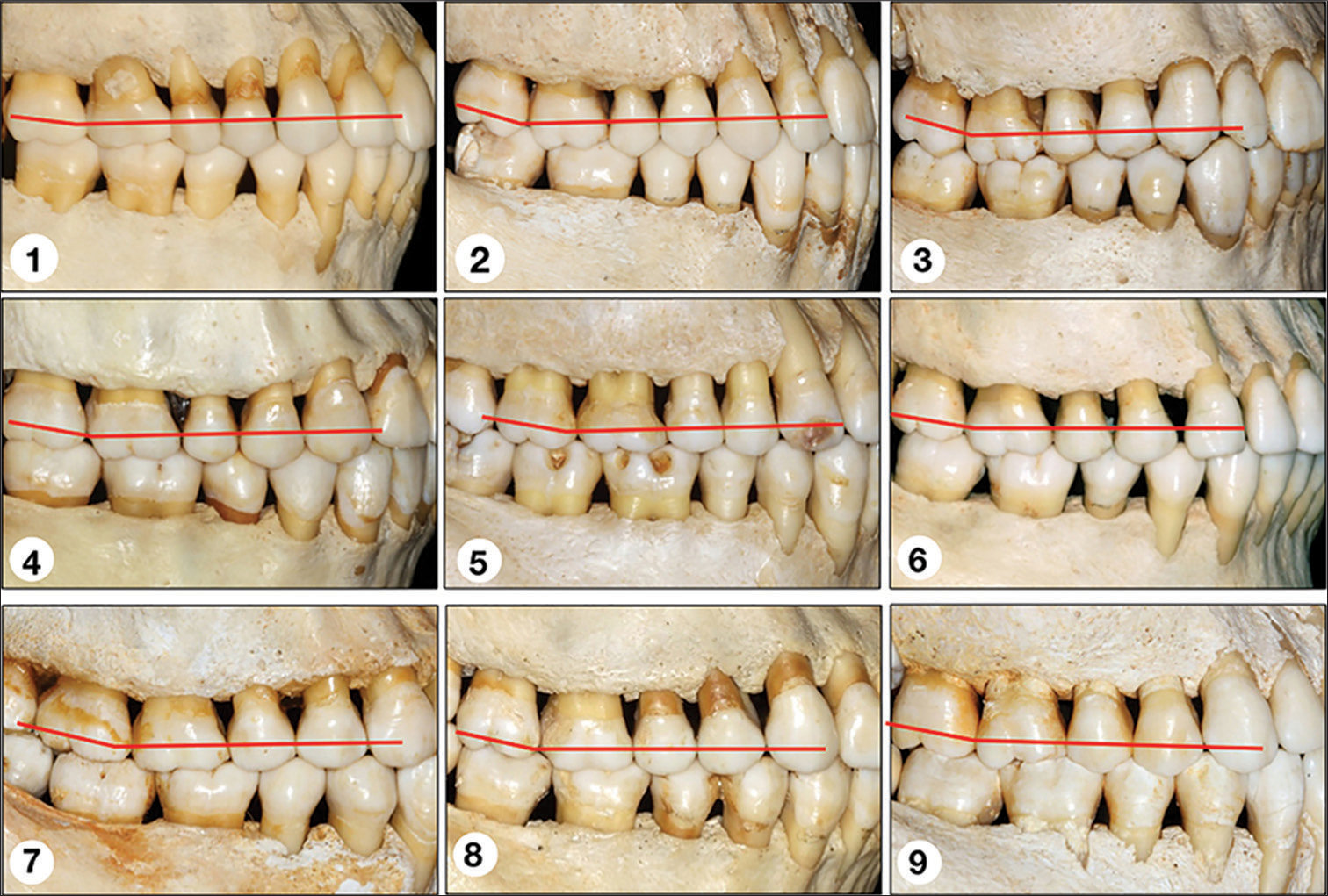 Observe the position of the second molars in a collection of skulls with normal occlusion. These teeth are in a more superior position to the occlusal plane and at a slight angle to the distal