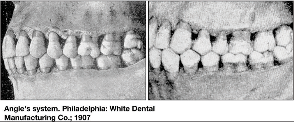 Normal occlusion illustrations from the Angle’s book (1907). The same characteristic position of second molars can be observed