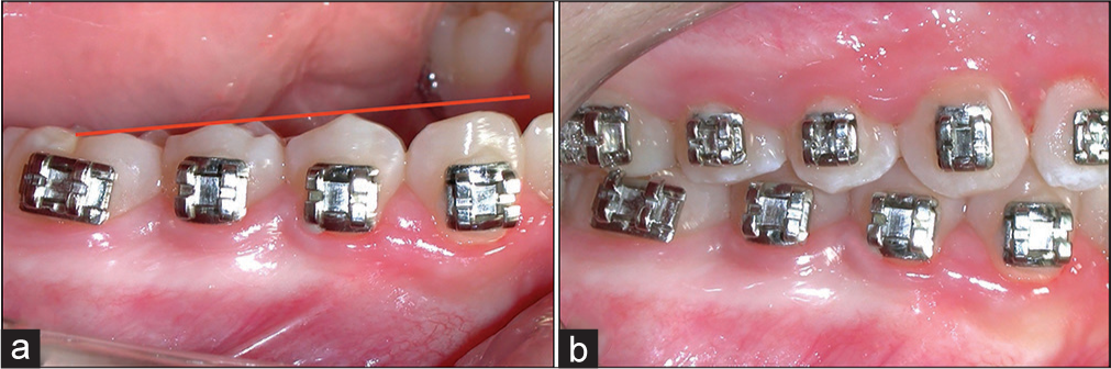 (a) A technical approach to improve the occlusal contacts in this area and avoid rebonding or bending archwires. (b) With bracket more cervical in the first premolar than the canine, it is possible to get an excellent intercuspidation in this area