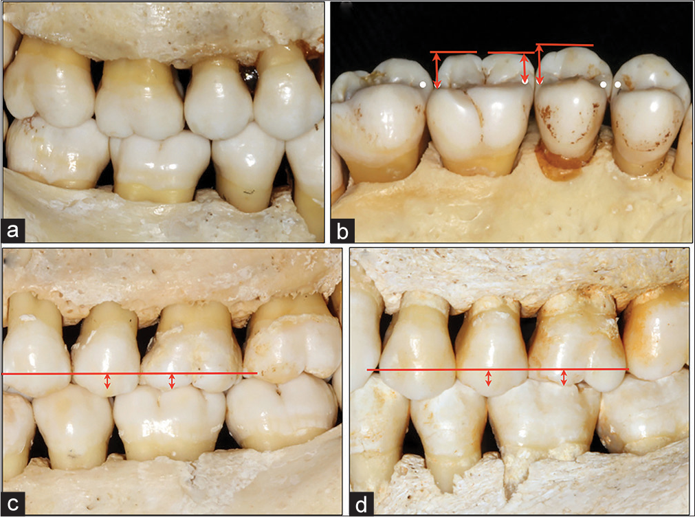 (a) Excellent intercuspation. (b) The height of the mesial buccal cusp of the first molar is always lower than the buccal cusp of the second premolar, up to about 1mm. (c and d) It is not possible to mount correctly from a height of cusp; however, it is necessary taking into account the marginal ridges