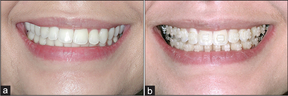 (a) A case with asymmetric smile and alteration of the occlusal plane and the smile line. (b) The significant improvement of the occlusal plane and the smile line