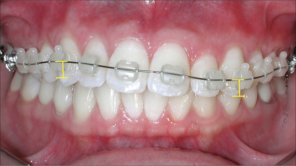 The appliance was mounted according to the malocclusion. The height of the canine bracket from one side is different to other side with the leveling resulting in a significant improvement