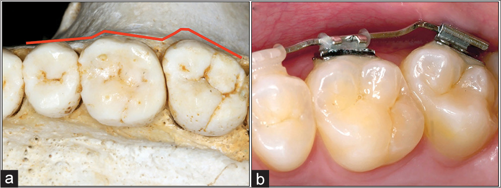 (a and b) In some cases will be necessary increase or decrease bend in archwires to get better teeth alignments