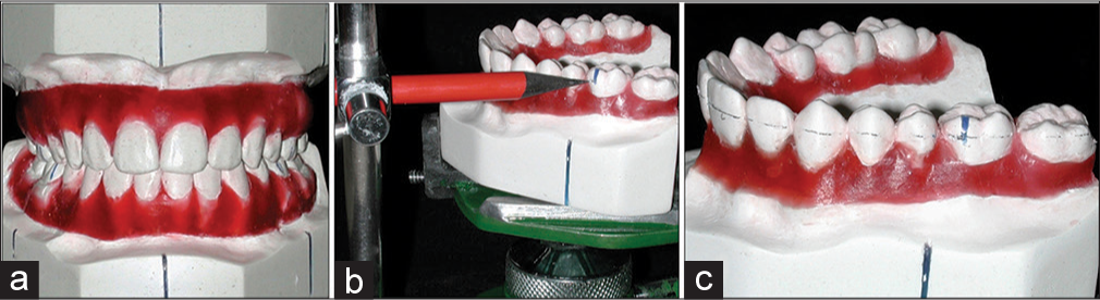 To solve the problem of inaccurate bracket placement, (a) traditional or a virtual set-up can help. (b) Marking the standard height in molars and incisors. (c) A horizontal line is drawn by marking a central position of the orthodontic bracket slots