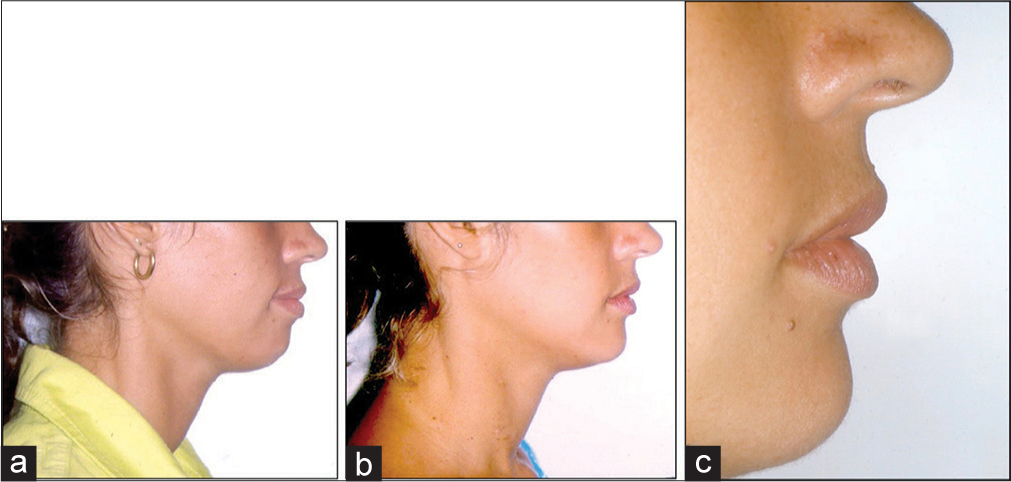 Premolar extractions can be beneficial to facial profile. (a) Before treatment. (b) After treatment and (c) close view of the face profile