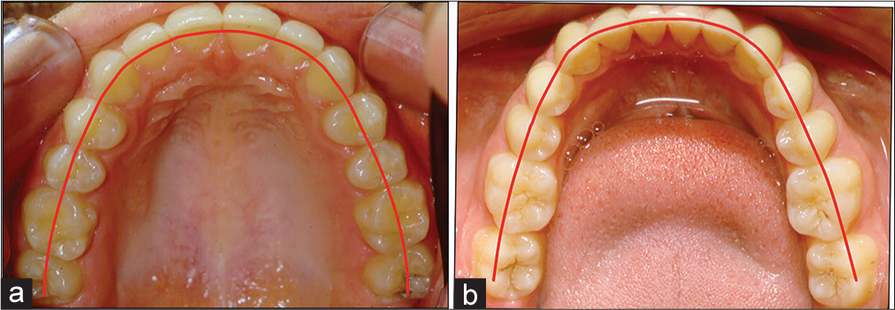 (a and b) Correct alignment of the maxillary teeth and the