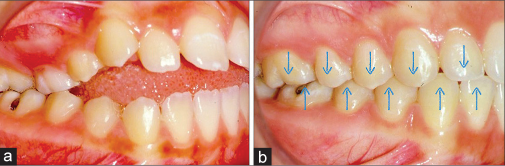 Occlusal contacts. (a) At the beginning of treatment and (b) after treatment the correct and maximum intercuspation of opposing teeth