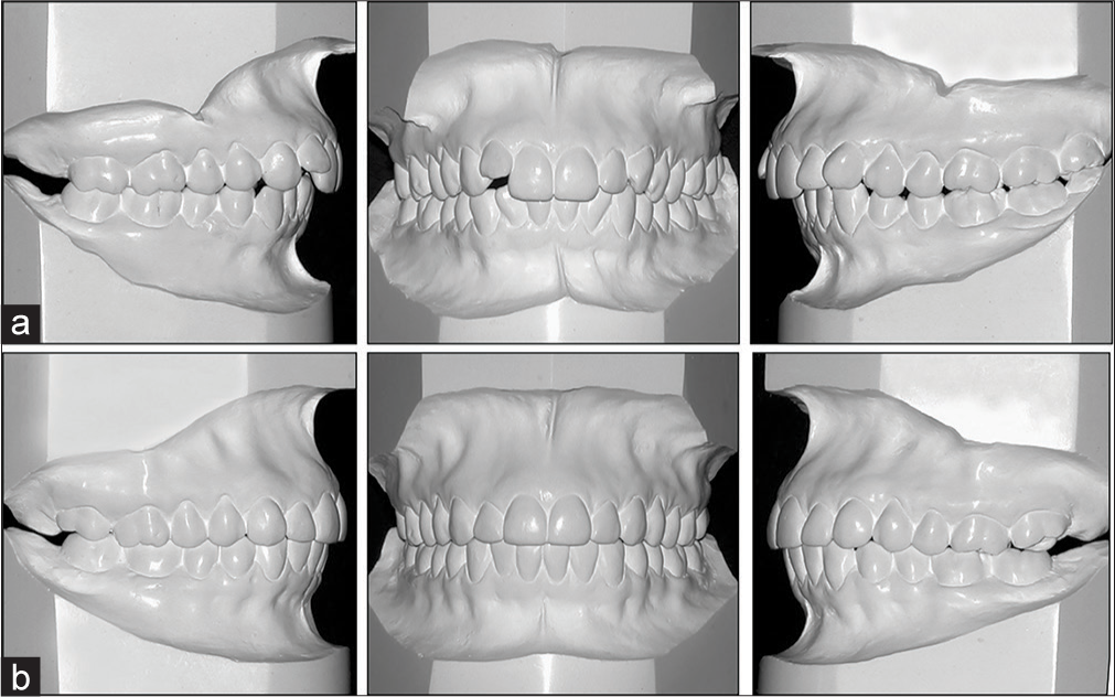 (a) Clinical case before and (b) After treatment where occlusal relationship of all teeth can be observed with its occlusal contacts, correct anterior torque, and a flat occlusal plane